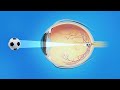 Nearsightedness (Myopia)