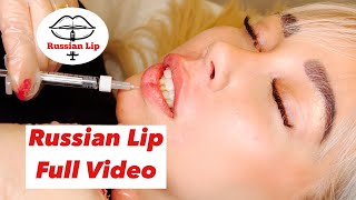 Russian Lip Technique 2023 method - full Injection video