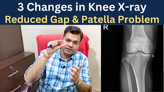 Knee x ray, Knee Osteoarthritis Gap Reduced, Chondromalacia patella, Knee Joint Degeneration