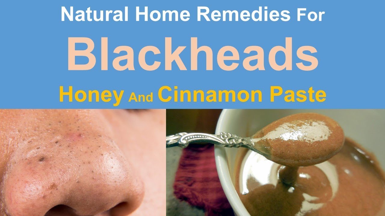 Natural Home Remedies For Blackheads - Get Rid Blackheads With Honey ...