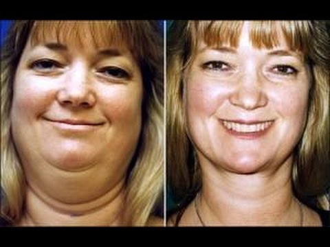 Lose fat from face Lose fat from face