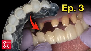 HOW TO Reline Provisional for an Ideal TEETH Orientation | Ep 3