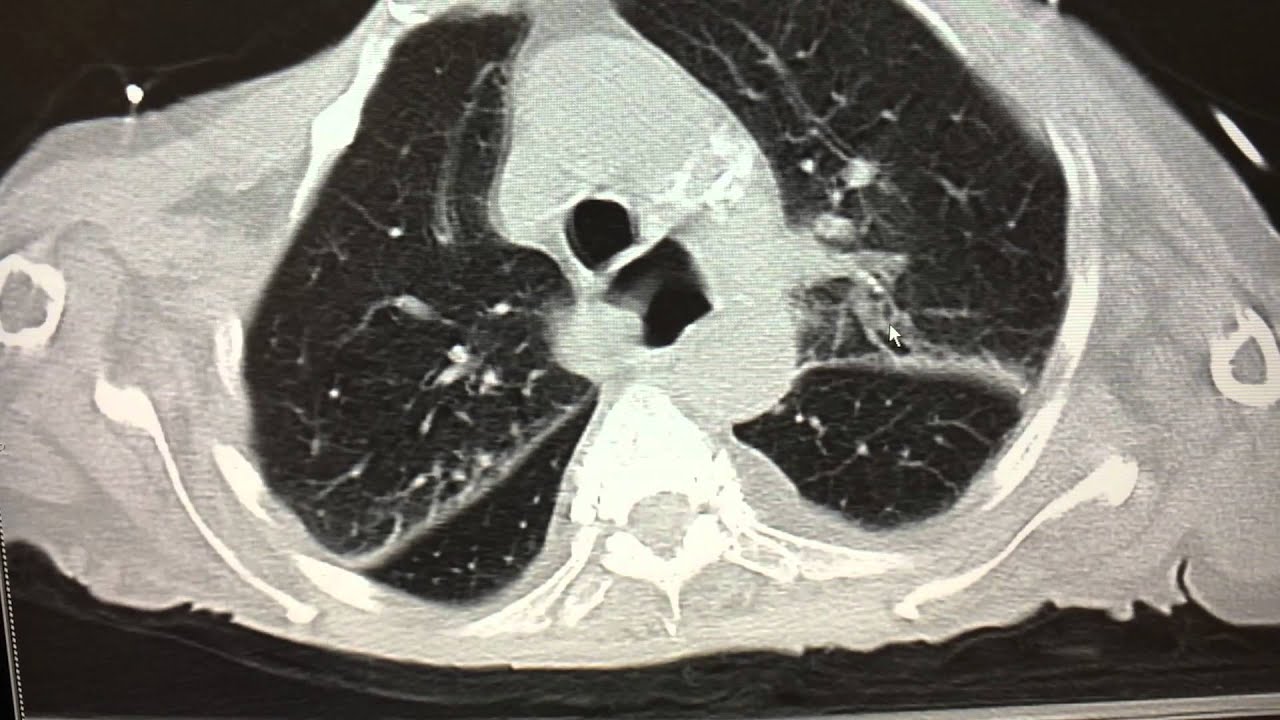 Abnormal Chest Ct Scan