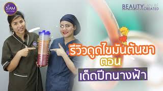 รีวิวคุณเบียร์ ดูดไขมันต้นขา ตอนเด็ดปีกนางฟ้า ::: [Siam Loft Clinic]