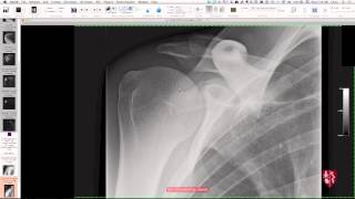 Upper Extremity Case Conference: Shoulder Girdle