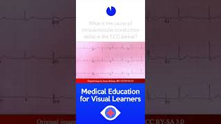 ECG Question