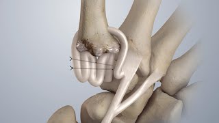 Osteoarthritis of the Thumb: Surgical Treatment (LRTI)