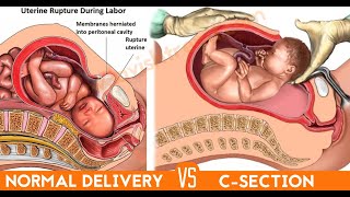 Medical Animation: Cesarean Delivery