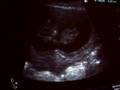 First Echo unborn child Menno & Monique
