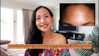 យល់ដឹងពីមុនកន្ទួលតូចៗ​(Fungal​ Acne)នឹងវិធីព្យាបាល