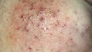 Blackhead Removal, Acne Treatment, So Many Blackhead On Face #36