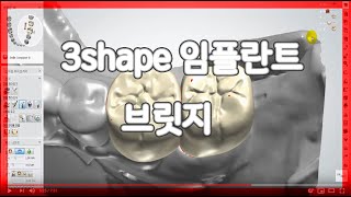 3shape 임플란트 브릿지 지르코니아 디자인 (여러 꿀팁이 들어있어요)