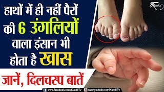 The nature of people with 6 fingers| 6 उंगलियों वाले इंसान कैसे होते हैं ?