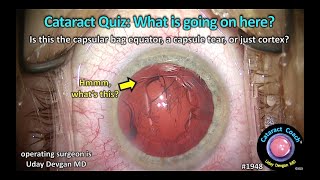 CataractCoach™ 1948: Cataract Quiz: bag equator, capsule rip, or cortex?