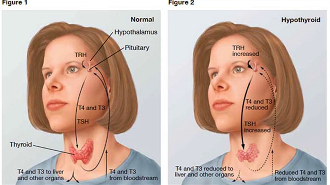 Goiter Symptoms- Goiter- Need Of A Doctor - YouTube