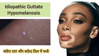 Idiopathic Guttate Hypomelanosis | सफ़ेद तिल और सफ़ेद दाग़ में फर्क #IGH #vitiligo #leucoderma #सफ़ेद