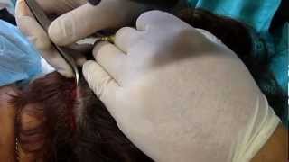 FUE Unshaven Hair Transplantation for women #advancedhairclinics