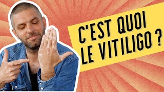 C'EST QUOI LE VITILIGO ?