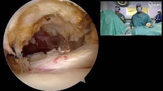 arthroscopic subscapularis repair  \