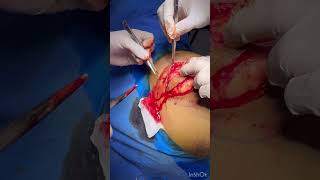 Very Large sebaceous cyst excsion under local anaesthesia… રસોળી ની ગાંઠ નું ઓપરેશન….