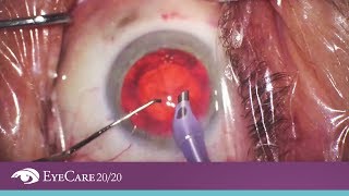 Femto Cataract Surgery