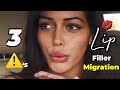 Do II have bad looking lips? | 3 Signs You have Lip Filler Migration #shorts #lipfiller #migration