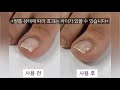 🌈크랄레 파고드는 발톱 브레이스 사용하는방법🌈ingrowntoenail krall brace how to use🌈