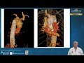 the past present and future of complex aortic intervention