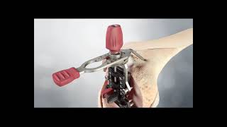 Attune Primary FB - Surgical Technique Animation