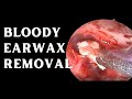 KERATOSIS OBTURANS - THE WORST EARWAX DIAGNOSIS