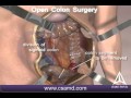 Colorectal cancer surgery - Open procedure - 3D animation