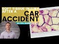 SOFT TISSUE INJURY AFTER CAR ACCIDENT