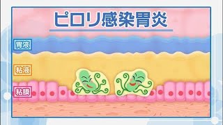 【NHK健康】ピロリ菌とは？検査の必要性・症状セルフチェック（胃がんや胃潰瘍の原因）