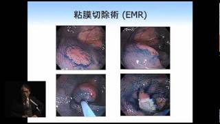 大腸がんとは？予防・検診の実際 - 斎藤 博