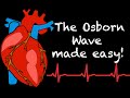 EMS Cardiology || Tachy Tuesday: The Osborn Wave in EMS