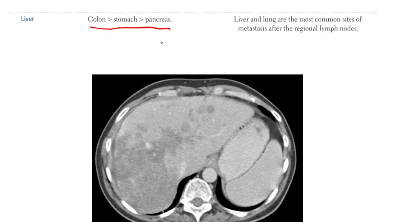 Pathology Neoplasia Part 3 Youtube