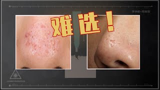 鼻子痘坑优选环钻还是光电 ？Scars on nose ！Punch grafting or energetic euipments?