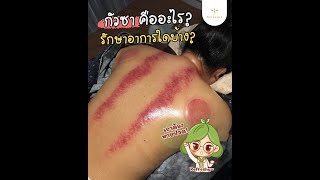 กัวซา คืออะไร? รักษาอาการปวดใดได้บ้าง? | Refreshy Clinic