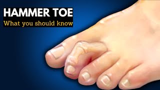 Hammer Toe or Mallet Toe, Causes, Signs and Symptoms, Diagnosis and Treatment.