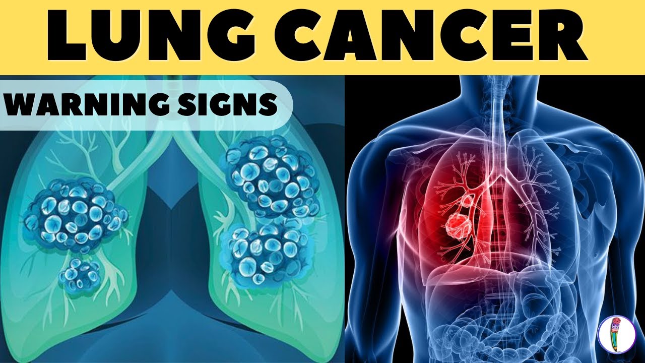 Warning Signs Of Lung Cancer