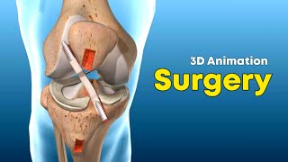 ACL (Surgery)- Knee Ligament Surgery ACL Repair - 3D Animation
