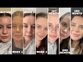 Our Nose Job Healing Journey Week by Week : WEEK 1 -- 3 MONTHS POST OP