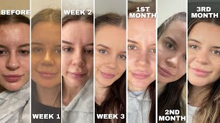 Our Nose Job Healing Journey Week by Week : WEEK 1 -- 3 MONTHS POST OP