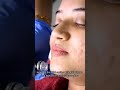 Hydra facial I 7306472962 I Shafna nisam