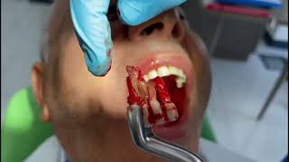 Büyük kronik iltihaplı 2 dişin birlikte çekimi // Extraction of 2 teeth together