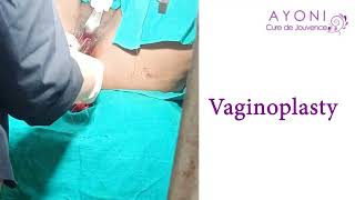 Vaginoplasty | Aesthetic Genital Plastic Surgery | Vaginoplasty by Dr Gaayatri Juneja