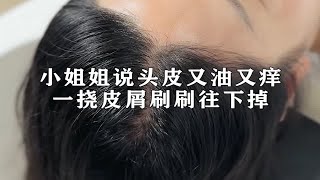 小姐姐说头皮又油又痒，一挠皮屑刷刷往下掉