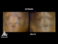 amerra 3d medical animation astanza trinity laser tattoo removal