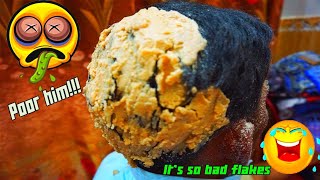 WOW KING FLAKES!!! NATURAL DANDRUFF SCRATCHING- BEST DANDRUFF PSORIASIS PICKING #199