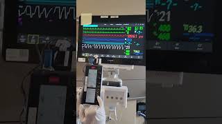 Epicardial Pacemaker checking thresholds